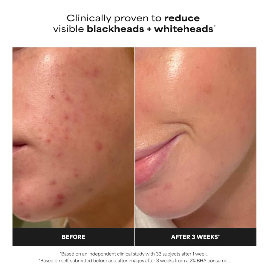 Paula’s Choice 2% BHA Liquid Exfoliant 4 oz | Salicylic Acid