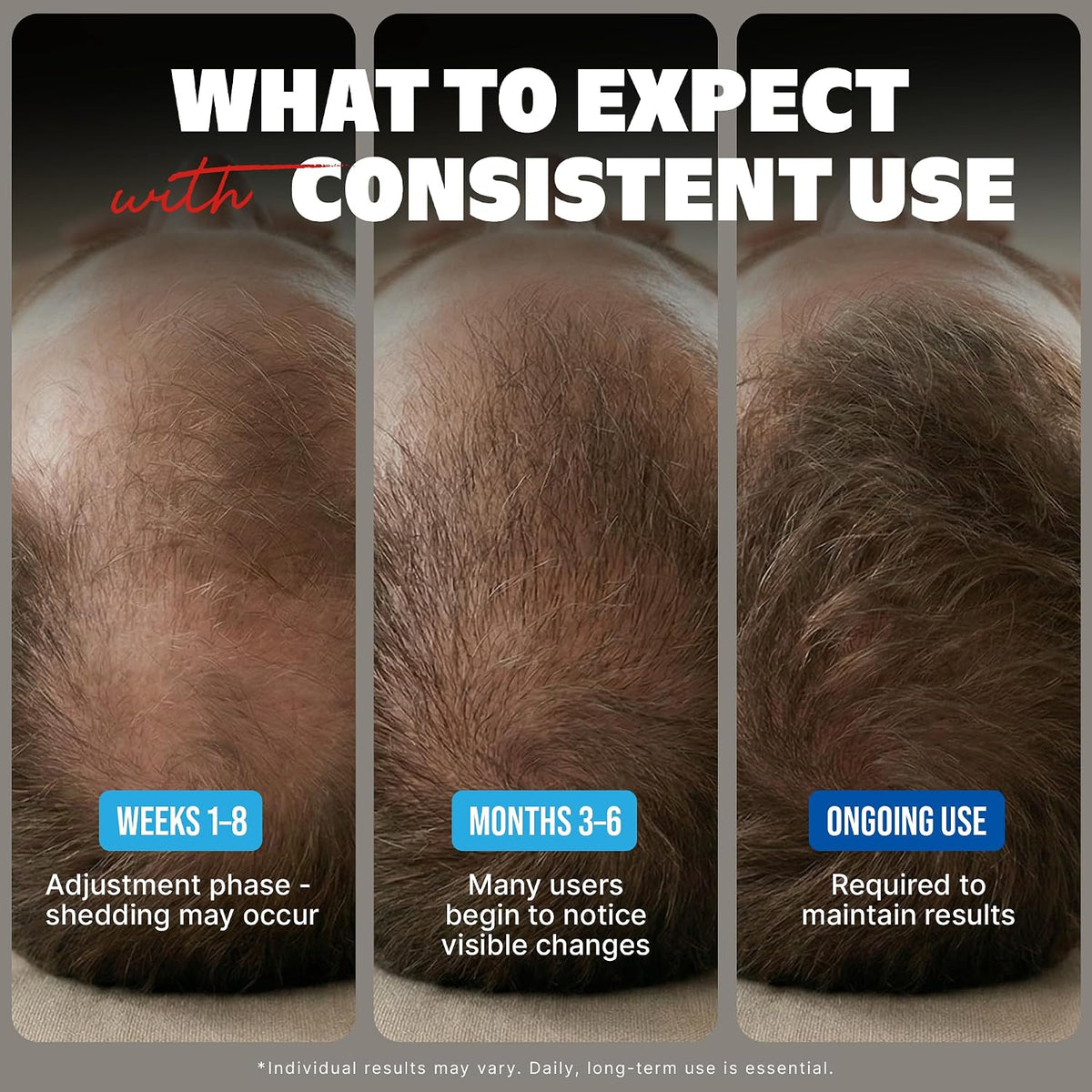Kirkland Signature Minoxidil 5% Extra Strength Hair Regrowth Treatment for Men – 6-Month Supply
